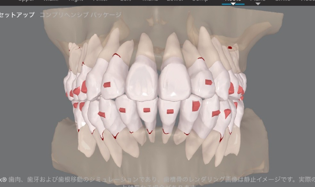 インビザラインの仕上がりは、クリンチェックで決まります