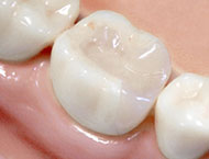 銀歯や変色した歯を白く自然な見た目の歯に改善