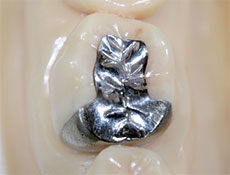 銀歯や変色した被せ物・詰め物を白くしたい