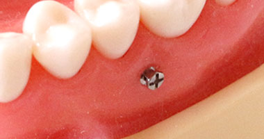 アンカースクリューの痛み