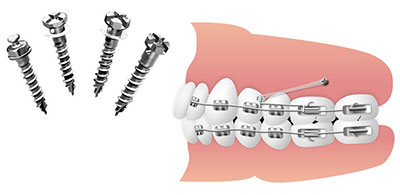 歯科矯正用アンカースクリューとは？