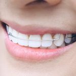 矯正治療のリテーナーについて