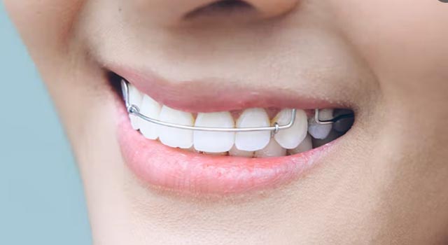 矯正治療のリテーナーについて