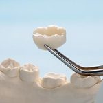 セラミック矯正のメリット・デメリット