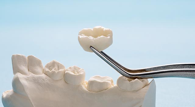 セラミック矯正のメリット・デメリット