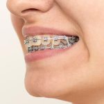 矯正で使用する『顎間ゴム』の役割をご存じですか？