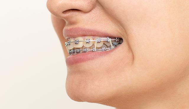 矯正で使用する『顎間ゴム』の役割をご存じですか?