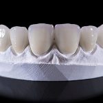 セラミックとジルコニアの違いをご存じですか？