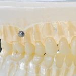 歯科矯正用アンカースクリューを使用した矯正治療とは