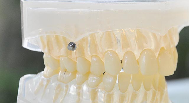 歯科矯正用アンカースクリューを使用した矯正治療とは