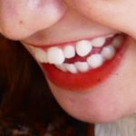 医院スタッフのインビザライン体験記ブログ【その1】