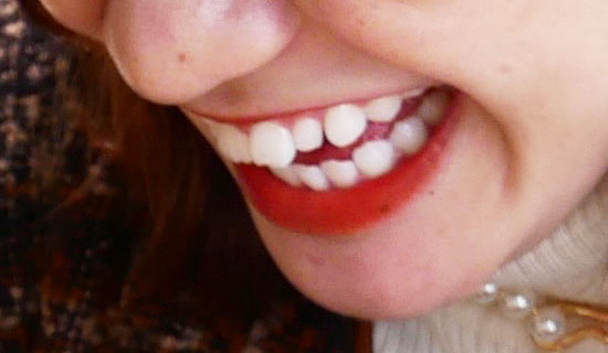 医院スタッフのインビザライン体験記ブログ【その1】