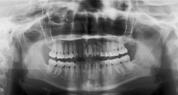 パノラマレントゲン