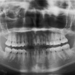 スタッフのインビザライン体験記ブログ【その2 精密検査】