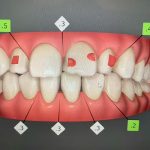 スタッフのインビザライン体験記ブログ【その3 治療計画】