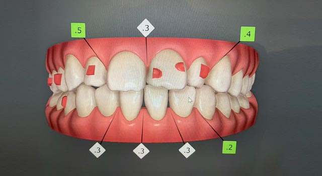 スタッフのインビザライン体験記ブログ【その3 治療計画】