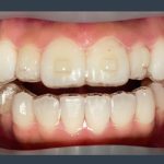 スタッフのインビザライン体験記ブログ【その6 デンタルモニタリング】