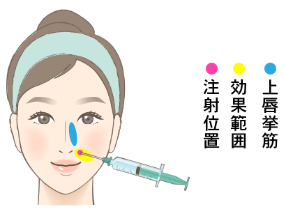 ガミースマイルボトックス施術方法