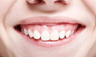 ガミースマイルボトックス