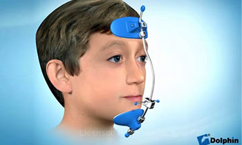 プロトラクター(上顎前方牽引装置)