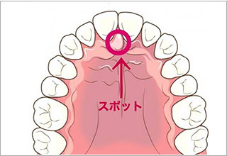 スポットポジション(正しい舌の位置を覚える)