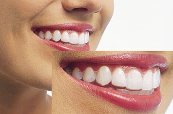 精密なマウスピースの作製