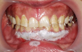 歯ぐきのガムピーリング