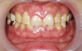 歯ぐきのガムピーリング