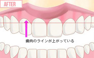 歯肉整形のイメージ