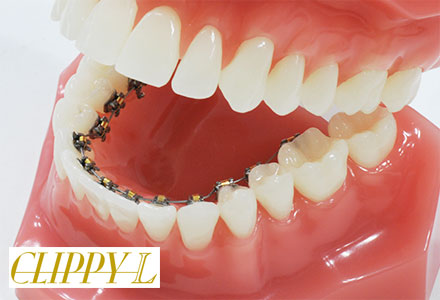 治療期間短縮が期待できるクリッピーLによる裏側矯正