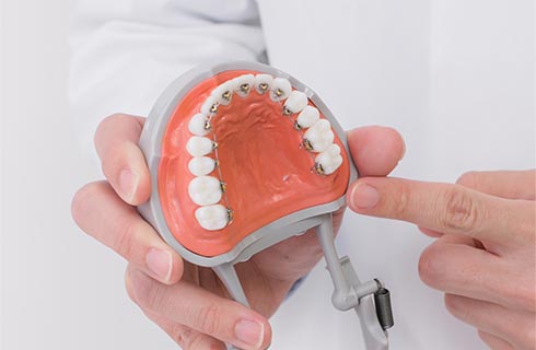 上顎には歯の裏側に矯正装置