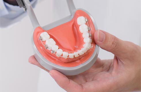 下顎には目立ちにくい表側矯正