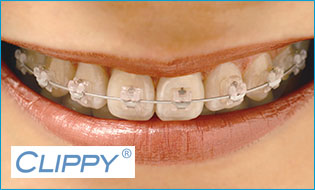 目立たない表側矯正