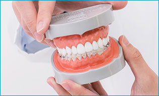 ハーフリンガル矯正