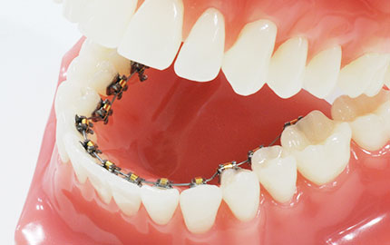 裏側矯正とは？