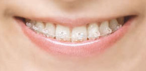 ホワイトワイヤーでさらに目立たない矯正