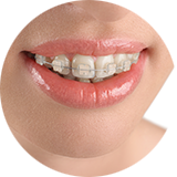 表側部分矯正の料金