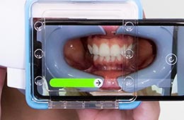 デンタルモニタリングで撮影